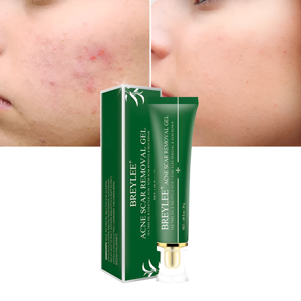 Green tube of acne scar removal gel with tea tree oil, 30g size, on white background