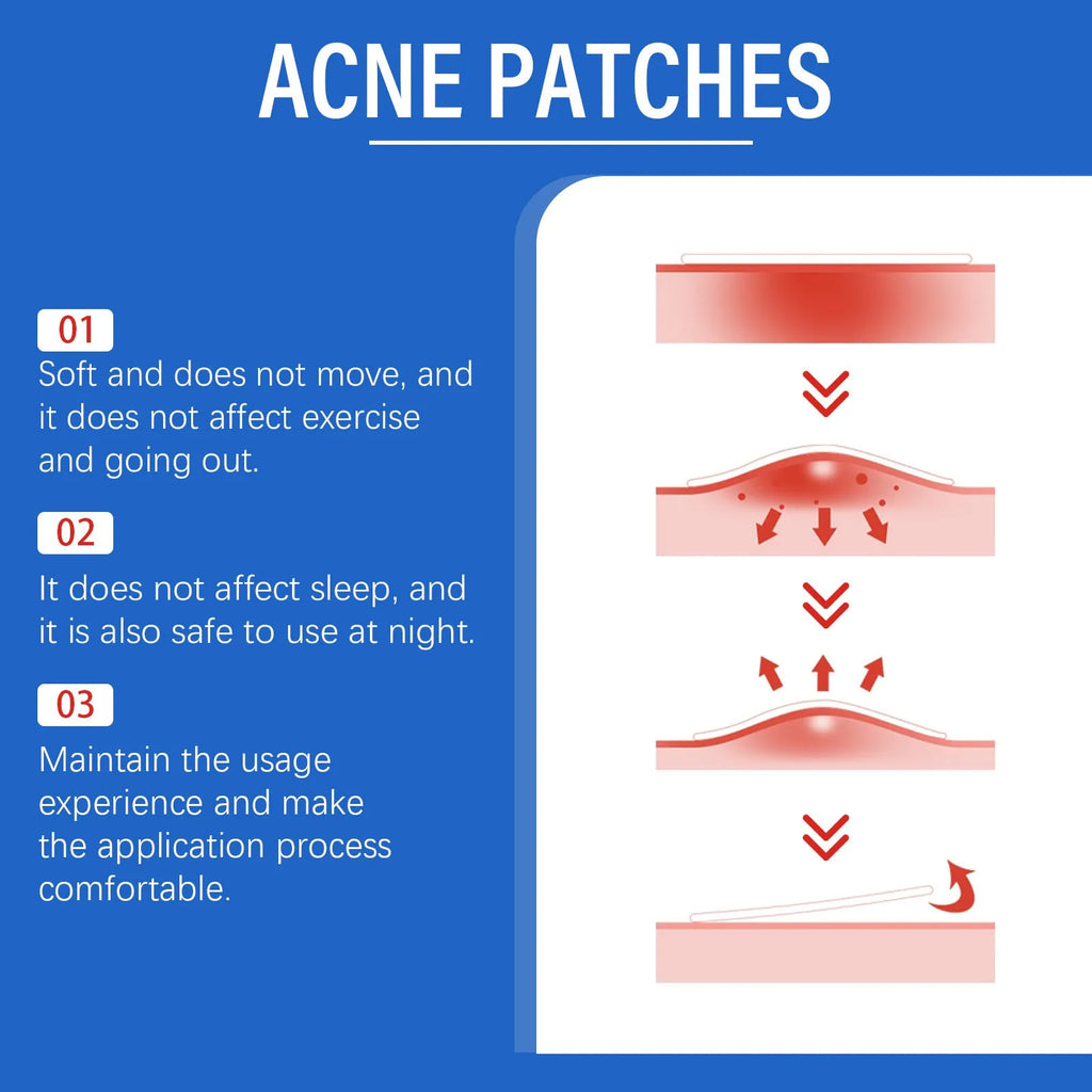 Acne patches with tea tree oil and vitamin E in 216-piece pack