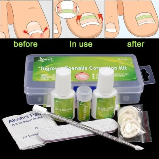 Nail patch kit with elastic strips, glue, debonding agent, alcohol wipes and grinding strips in a PP box